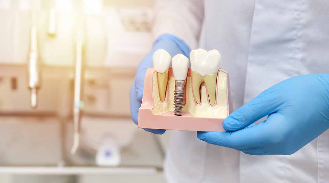 Dental implants in Naples, FL | Dr. George Mantikas, D.M.D 
