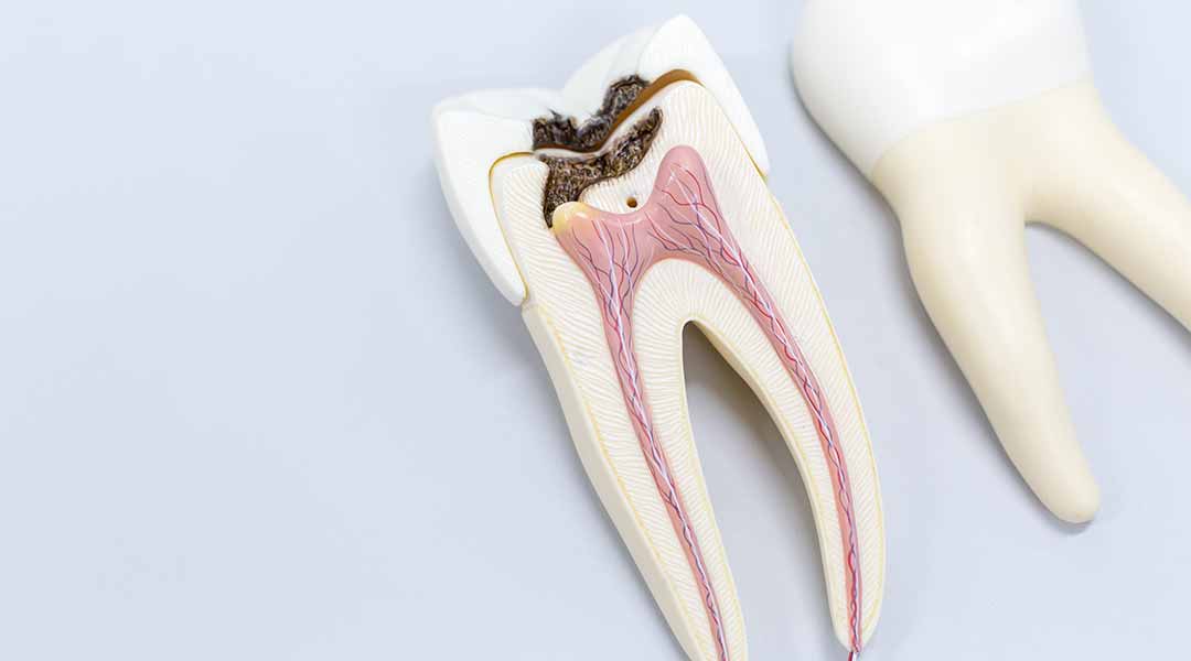 Root Canal Therapy in Naples, FL | Dr. George Mantikas, D.M.D 